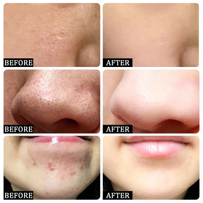 Salicylic Acid Pore Clearing C - Salicylic Acid Blackhead Remover recension och pris